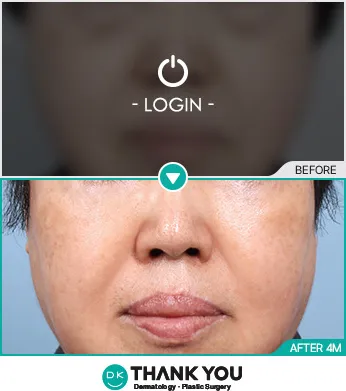 Before/After