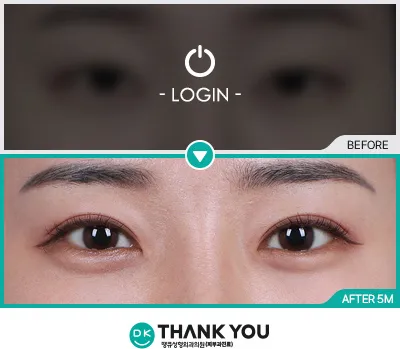 Before/After