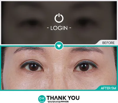 Before/After