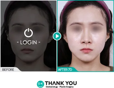 Before/After