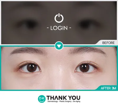 Before/After