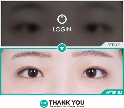 Before/After