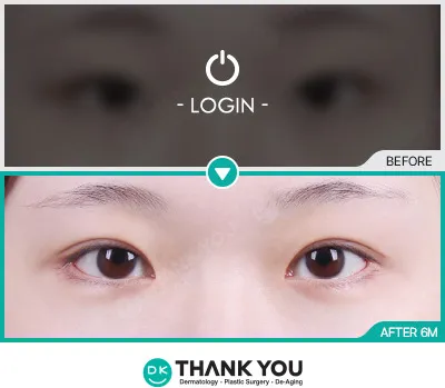 Before/After