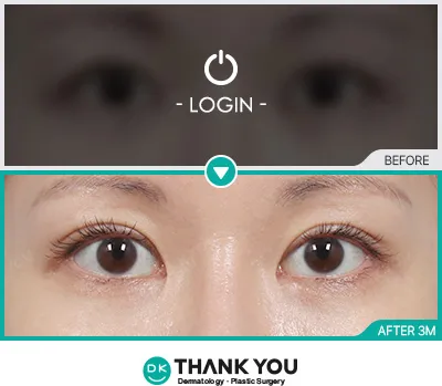 Before/After