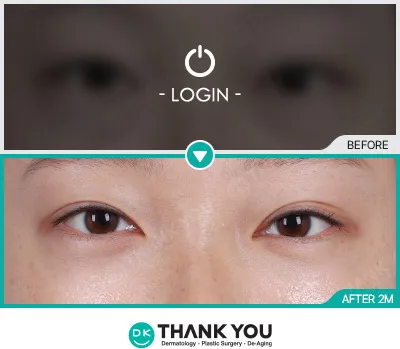 Before/After