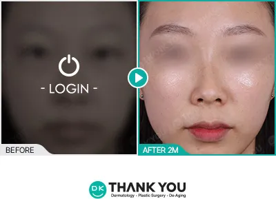 Before/After