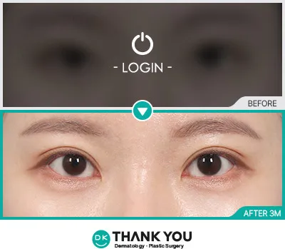 Before/After