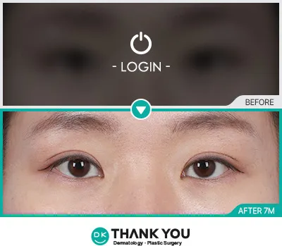 Before/After