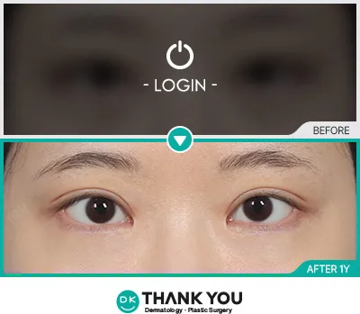 Before/After