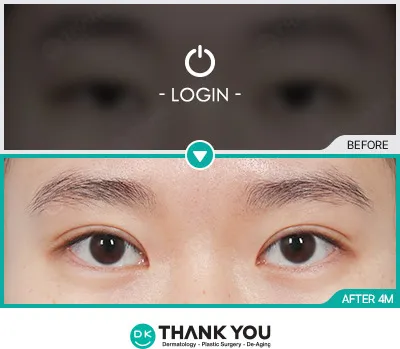 Before/After