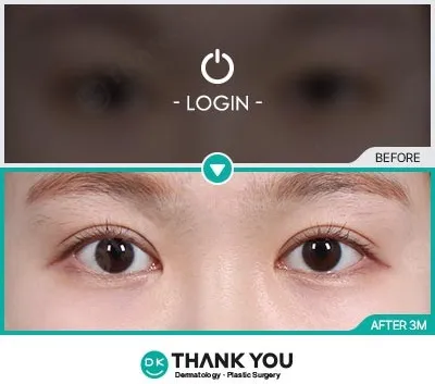 Before/After