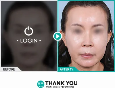 Before/After