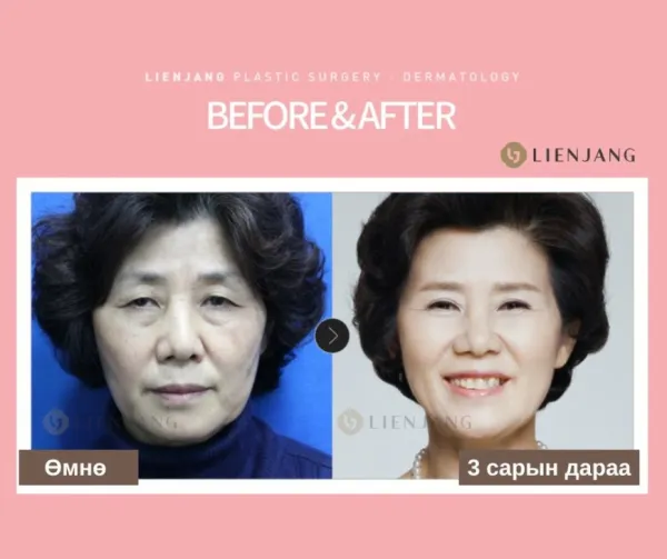 Before & After 