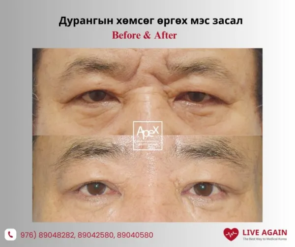 Дурангаар Хөмсөг өргөх мэс засал