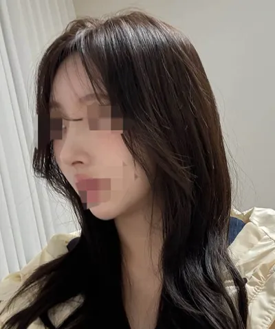 자가늑 코수술 대만족이에용 >< ㅎㅎ