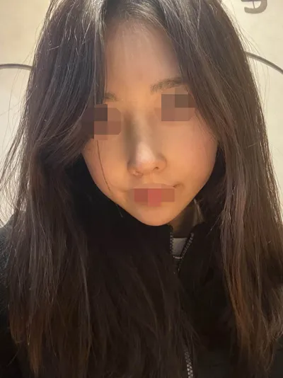 원트에서 자가늑 코수술 받았습니당!