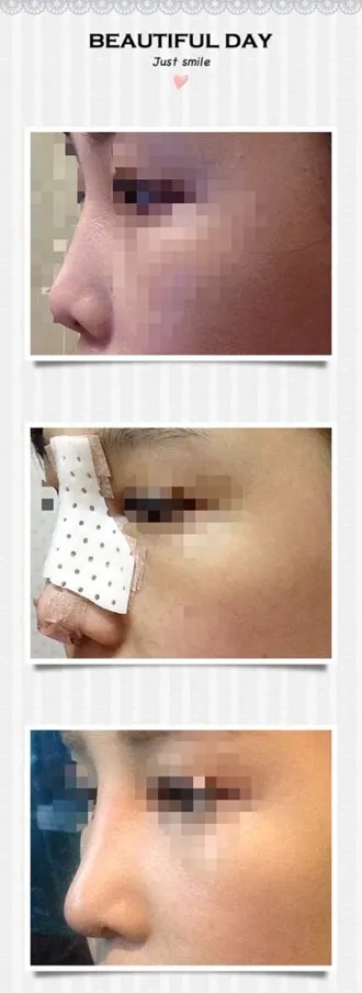 코 수술한지 10일째!!