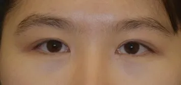 드디어 비절개 눈매교정으로 수술했습니당ㅋㅋㅋㅋㅋ