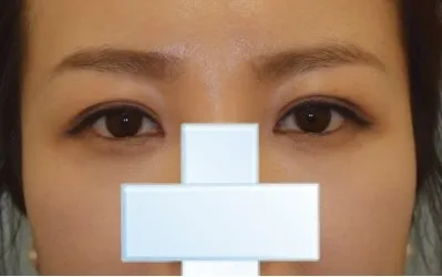 쌍커풀이 자꾸 풀려서 고민끝에