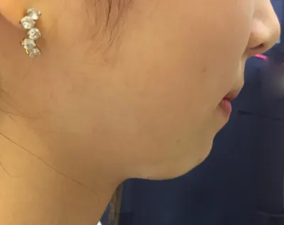 제가 무턱이 심해서 처음에 턱끝교정수술 생각도 했는데