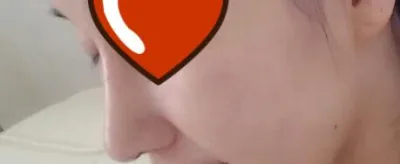 수능 끝나고 친구랑 같이 코수술을 했었는데