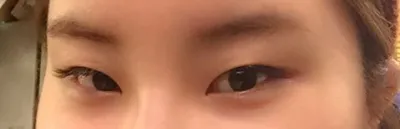 저 트임만 했을 뿐인데 눈이 이렇게 변했어요.