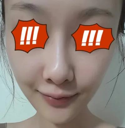 한달 정도 전에 지방이식 했던 선미예요. 다들 잘지내고 계시죠?