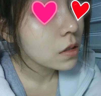 안녕하세요 코수술한지 일주일 좀 넘었는데 너무 자연스럽게 되서 자랑하러 왔어요