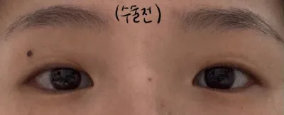 매몰+앞트임 후기