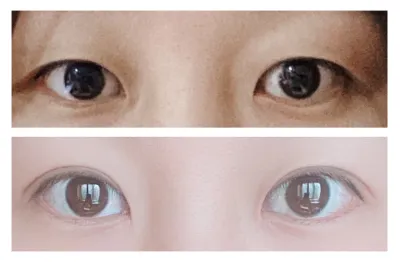 쌍꺼풀 3개월 후기
