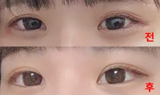 쌍수 성공했어요