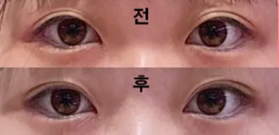 매몰로 수술했어요!