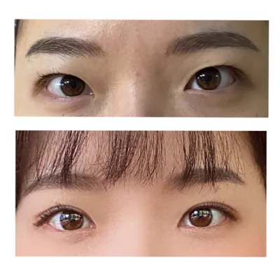 쌍꺼풀 매몰 + 앞트임 2달 후기입니다!