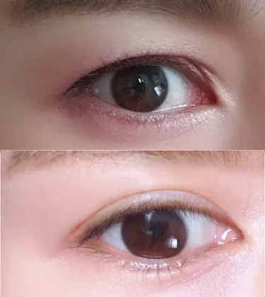 절개 눈매교정 만족해요!