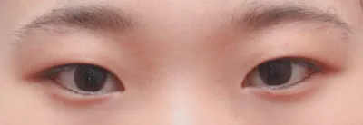 절개 쌍꺼풀 앞트임 수술 한달 차