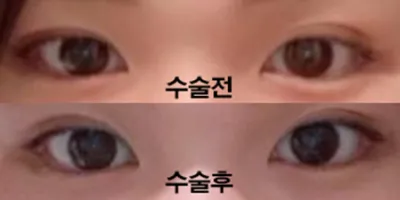 쌍꺼풀 재수술 3개월차입니다!