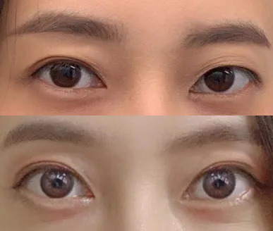 재수술 6개월차 후기