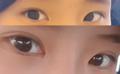 앞트임, 쌍꺼풀 재수술 2개월 후기입니다~