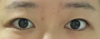 절개 쌍꺼풀 앞트임 5개월차 후기입니다