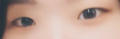 매몰쌍꺼풀 앞트임 후기입니다🥰