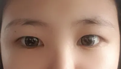 절개눈매교정 4개월 됐어요