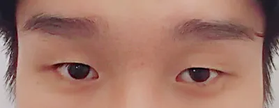 무쌍눈매교정, 앞트임 2주..