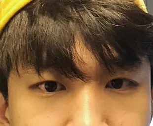 남자눈매교정 1달후기!