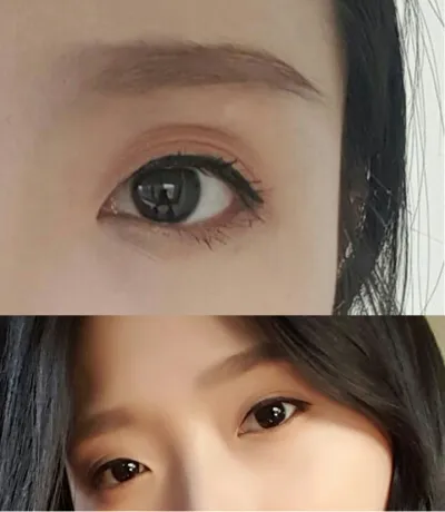 절개눈매교정+앞트임+상안검지방이식 6개월 경과 후기