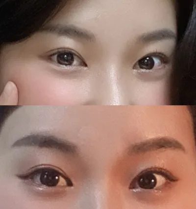 소세지눈 재수술, 앞트임 재수술, 뒤밑트임 1년만에 경과보고 왔어요