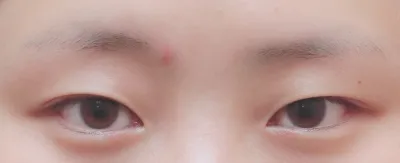 눈매교정 한달째^^