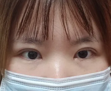 쌍수 재수술, 앞트임 실밥 푼 후기