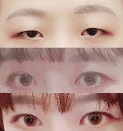 눈매교정, 앞트임 후기