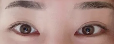 절개눈매교정, 앞트임 두달 됐어요