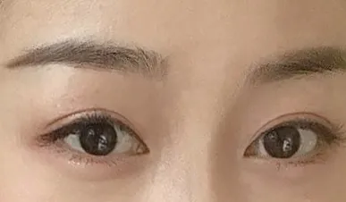 절개눈매교정, 앞트임 6개월 후기